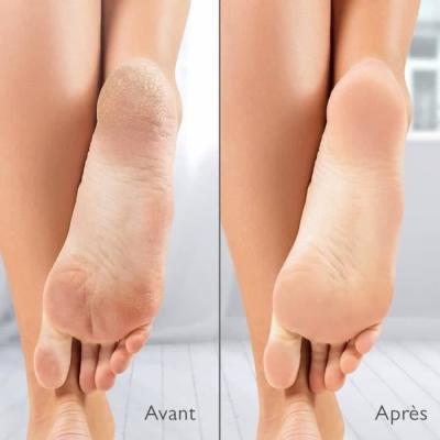 Râpe électrique anti-callosités avec aspiration - Silk'n Vacupedi