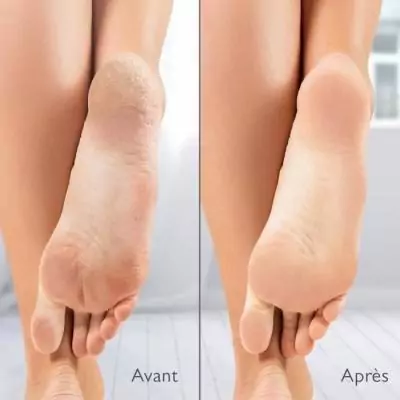 Râpe électrique anti-callosités avec aspiration - Silk'n Vacupedi Râpe électrique anti-callosités avec aspiration - Silk'n Vacupedi